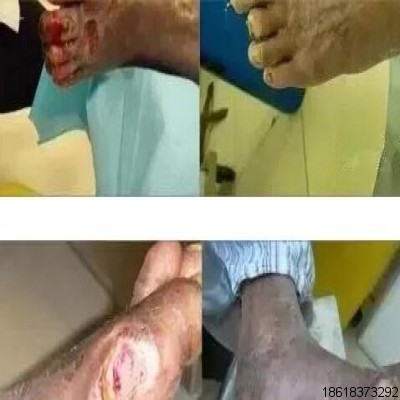 創(chuàng)面修復(fù)：三氧治療糖尿病足的優(yōu)勢